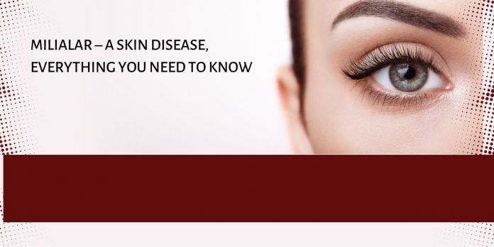 Milialar – A Skin Disease, Everything You Need To Know